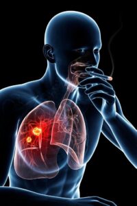 lung cancer