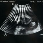 Budaun Ultrasound News