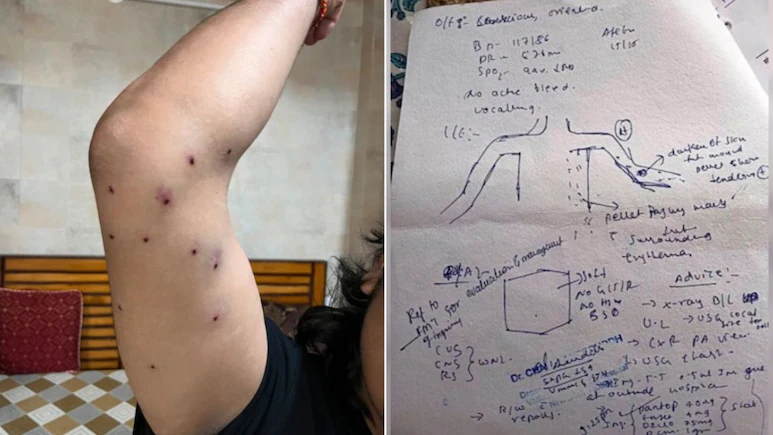 CJP Protest: Hospital Report Fuels Pellet Gun Row